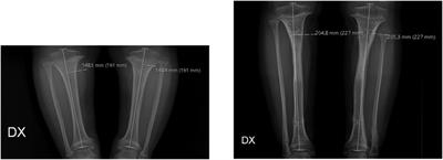 Results and complications of bilateral limb lengthening in achondroplasia: a retrospective analysis